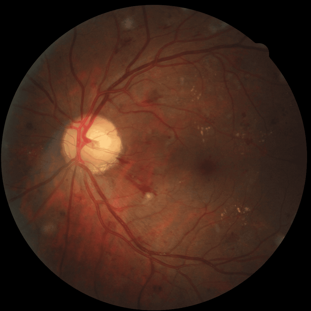 Fundus Image Scan